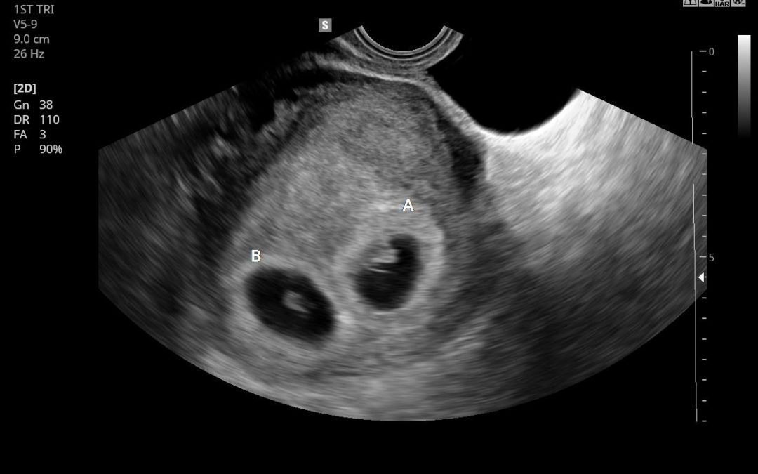 Twins Pending: the first trimester